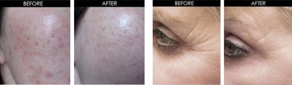 Microneedling - Before and After